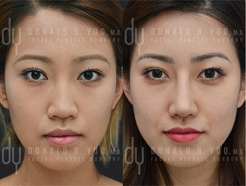 Asian Rhinoplasty Before and After (Woman)