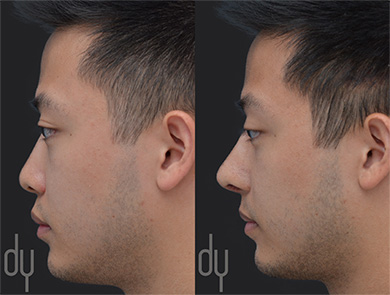 Asian Rhinoplasty Before and After (Men)