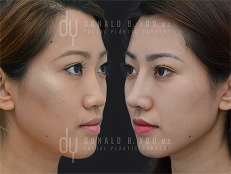 Asian Rhinoplasty Before and After